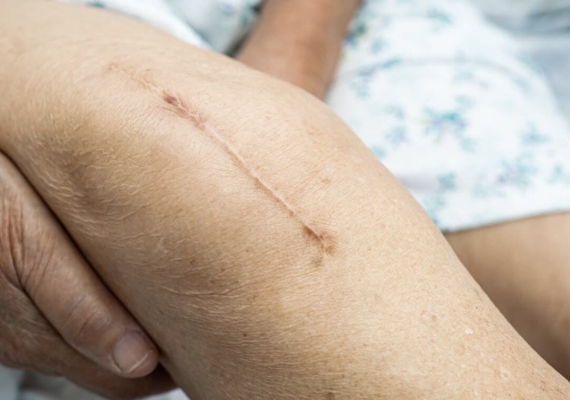 Scar therapy treatment